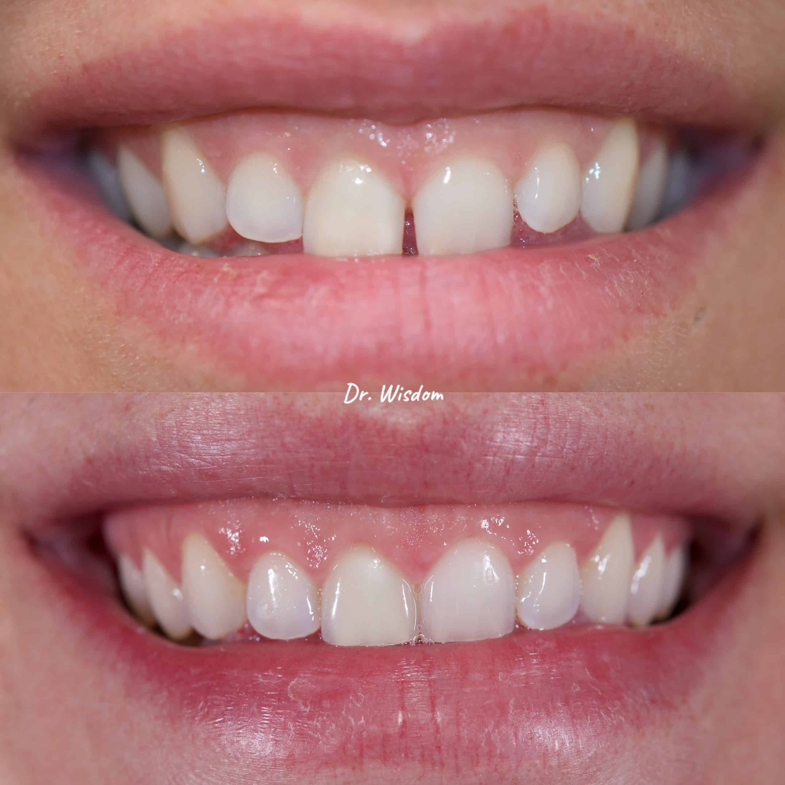 Montreal Invisalign Clear Aligners