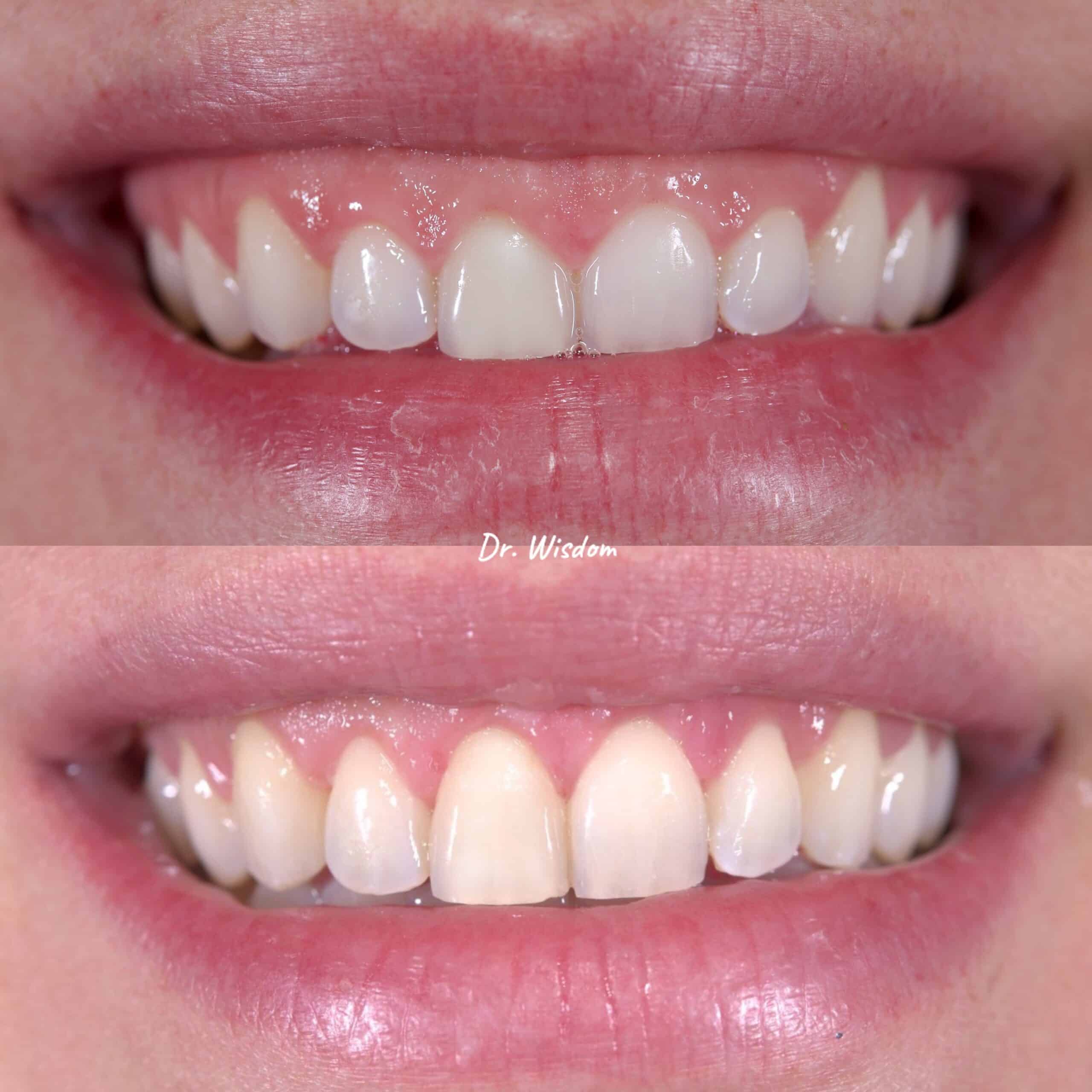Before and After: Gum Contouring