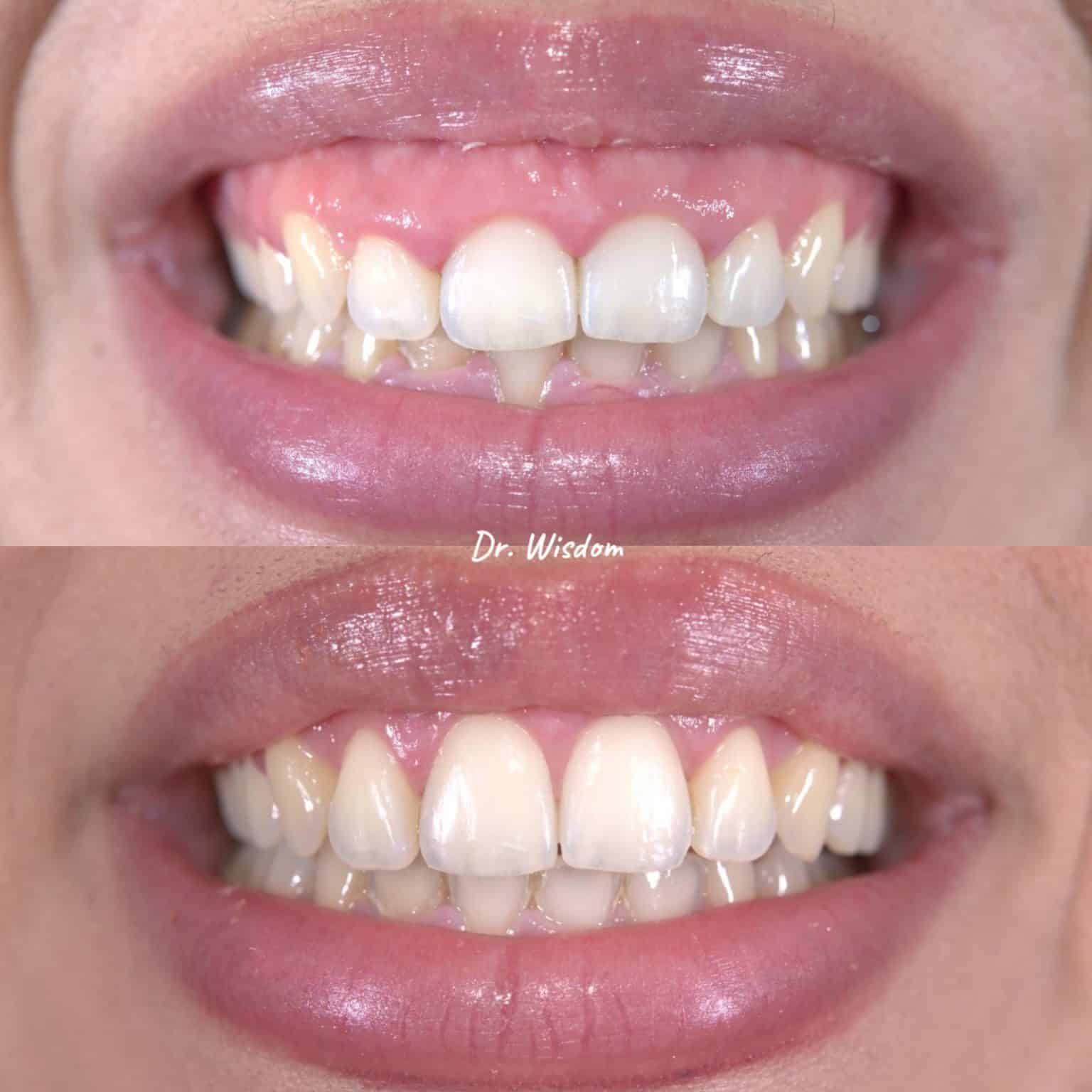 Before and After: Gum Contouring