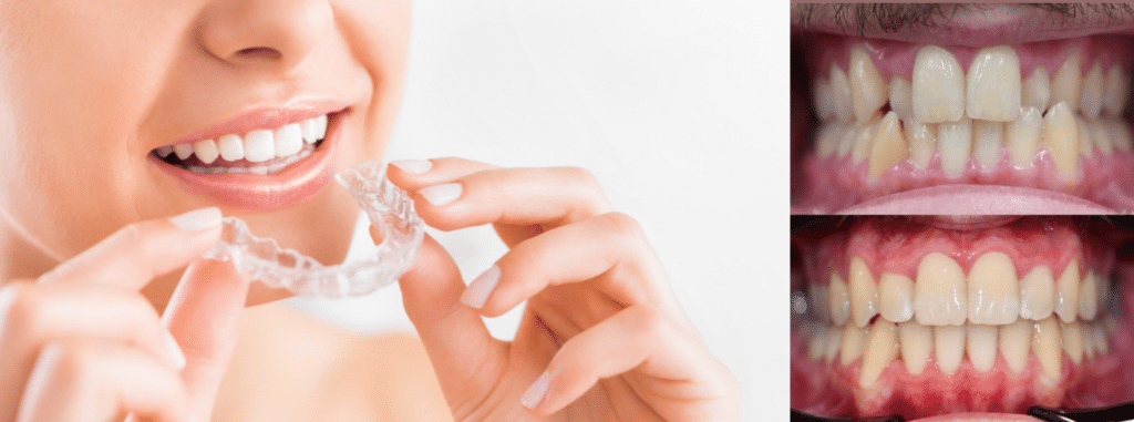 Montreal woman putting in an Invisalign retainer to correct crooked teeth