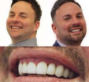 Pic of Man Before & After Montreal Invisalign Cosmetic Dentistry Treatment